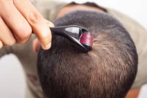 dermaroller for crown hair growth