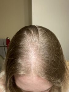 diffuse hair loss patient 2