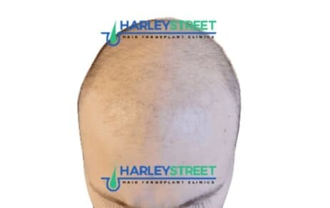 man with diffuse hair loss