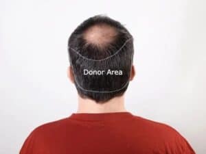 donor area for hair transplant