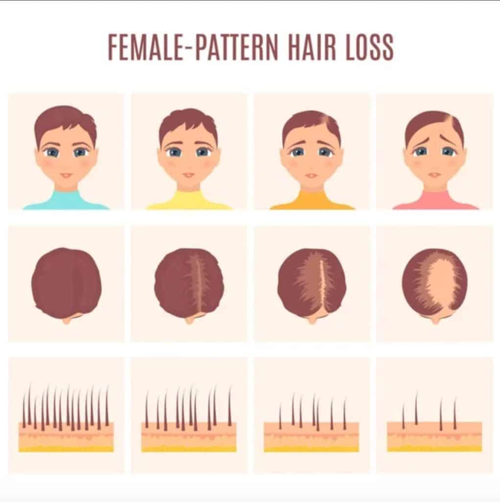 Female Pattern Baldness - Hair Loss in Women - Harley Street HTC
