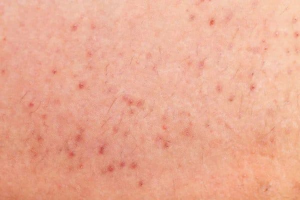 folliculitis on human skin