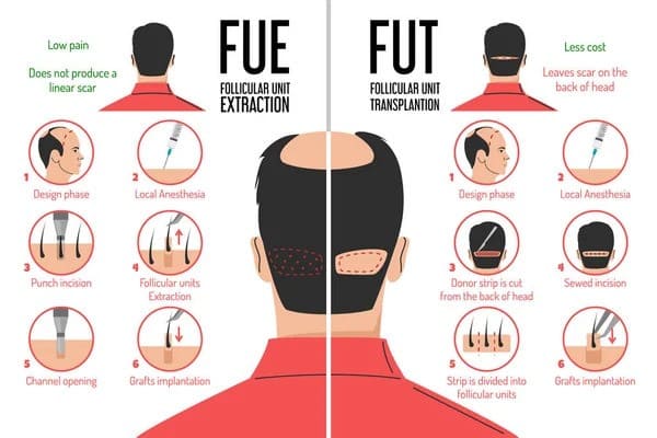 fue vs fut hair transplant