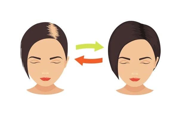 hair loss in women and why hair transplants aren't always a good choice