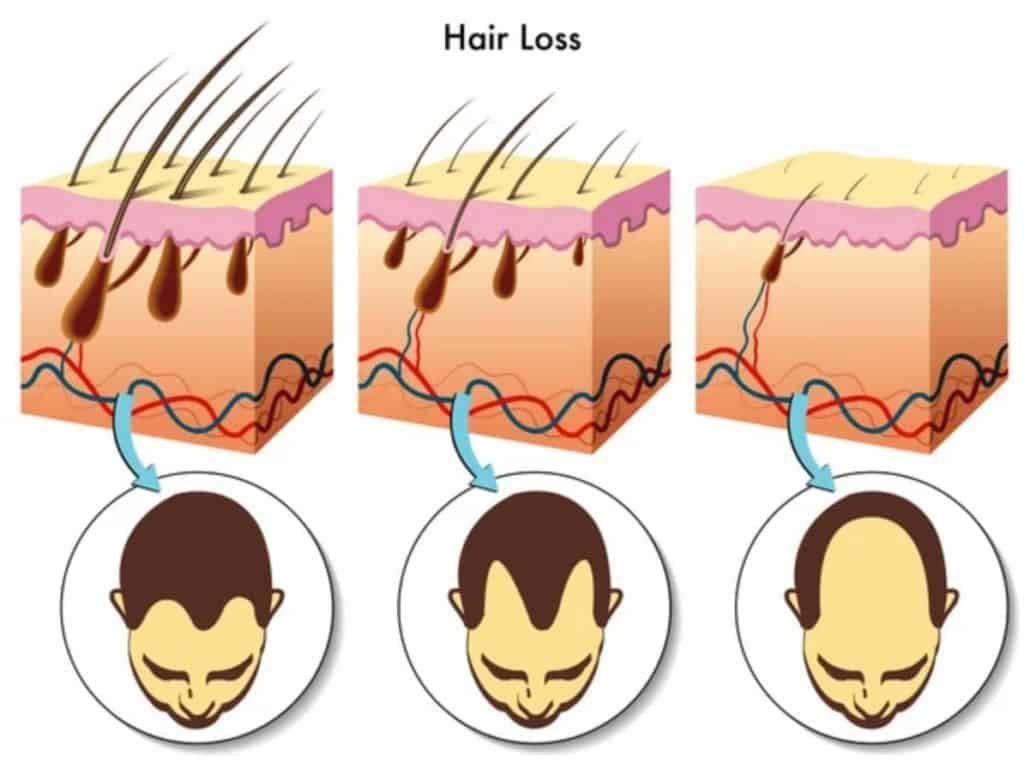 hair loss stages
