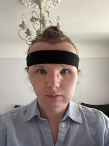 hair transplant peak swelling