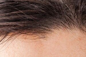 hair transplant repair close up