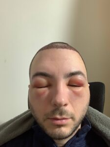 hair transplant swelling