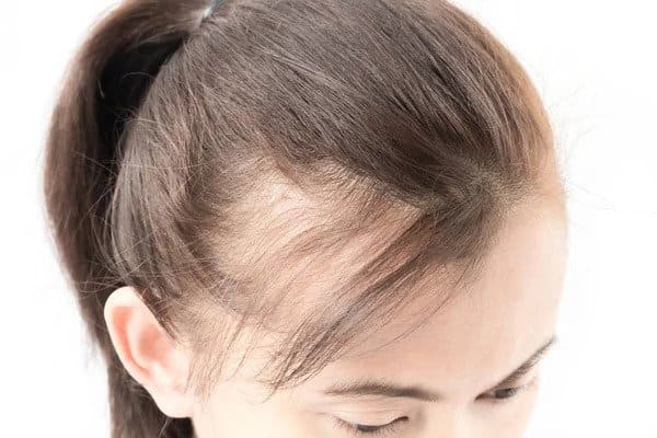 What Causes Hair Fall in Woman? | ClinicExpert