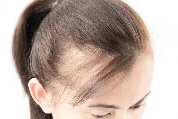 illnesses that cause hair loss in women