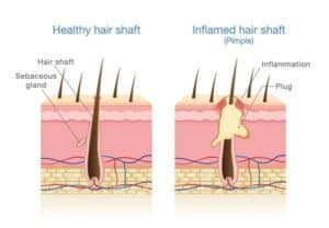 infected hair follicle