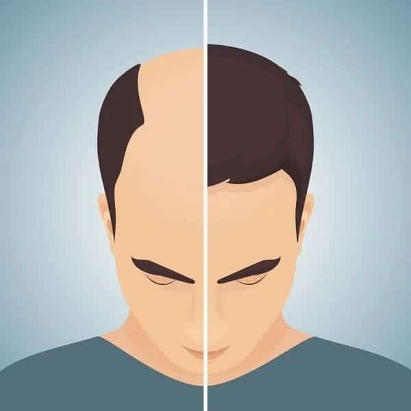 is hair loss genetic or hereditary