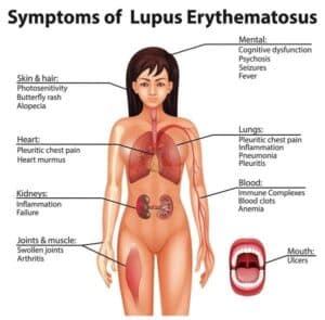 lupus and hair loss in women
