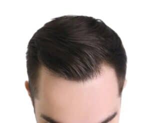 m shaped hairline on man
