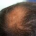 male crown hair loss