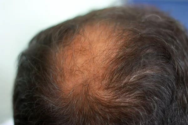 male crown hair loss