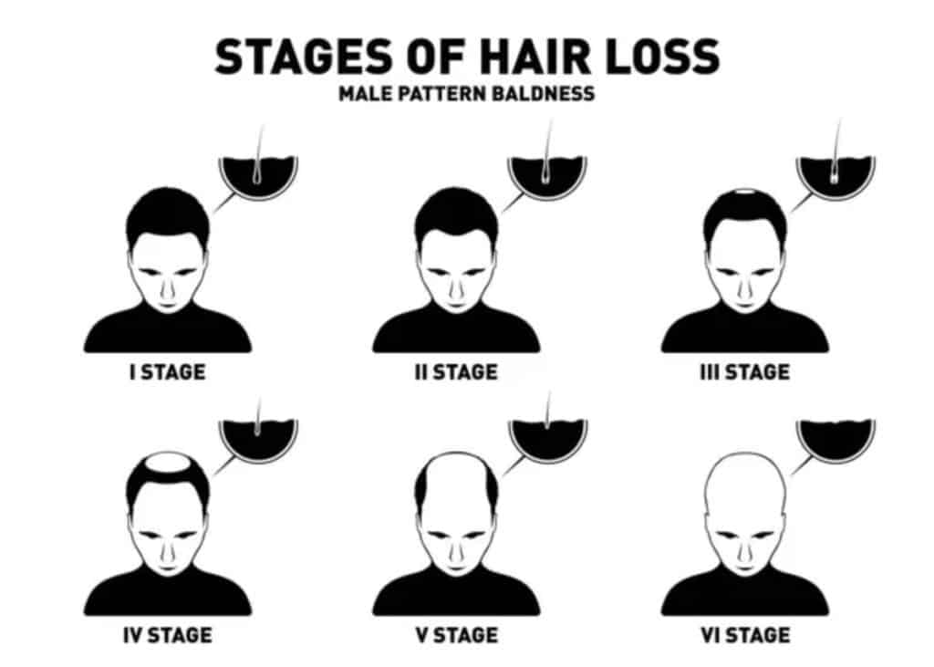 male pattern baldness