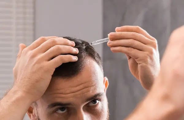 man applying topical finasteride to scalp