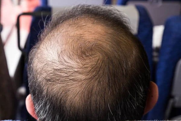 man balding on crown