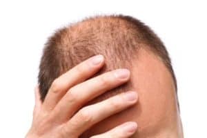 man suffering with hair loss