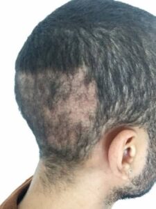 Hair Transplant Cost UK overharvested donor are 1