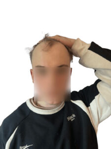 patient with receding hairline removebg preview