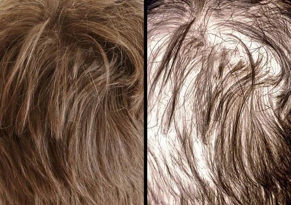 retrograde alopecia donor hair thinning