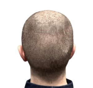 sergio_7_days_post_ht_donor