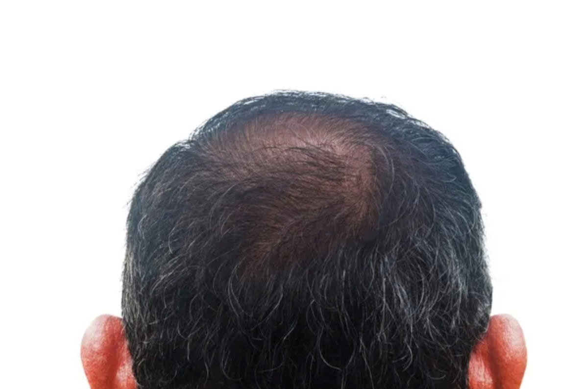 What are the different types of hair loss  BioCell Cosmetic Clinic