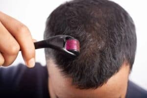 using a dermaroller for hair growth