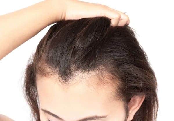 woman with a receding hairline
